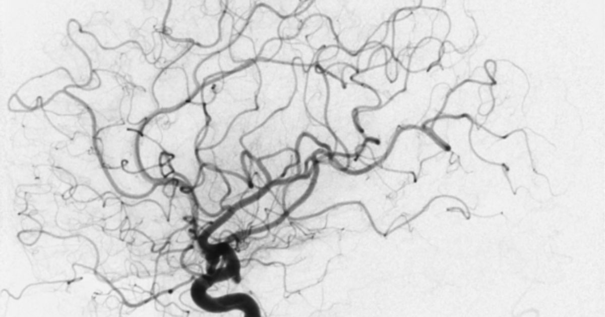 Angiografia O Que Voc Precisa Saber Sobre Esse Exame