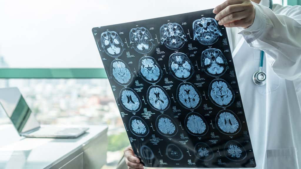 Qual a diferença entre AVC e aneurisma cerebral