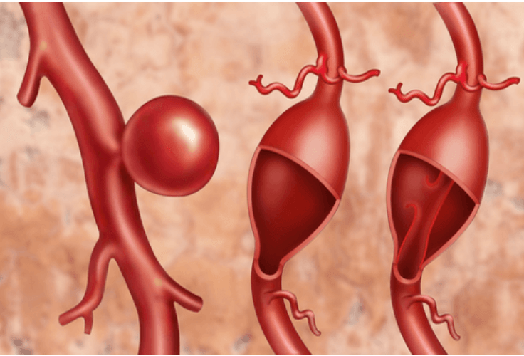 Aneurisma cerebral sintomas tratamento e prevenção