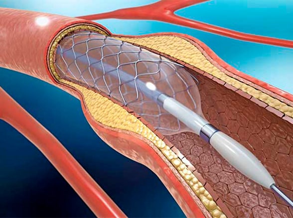 Angioplastia