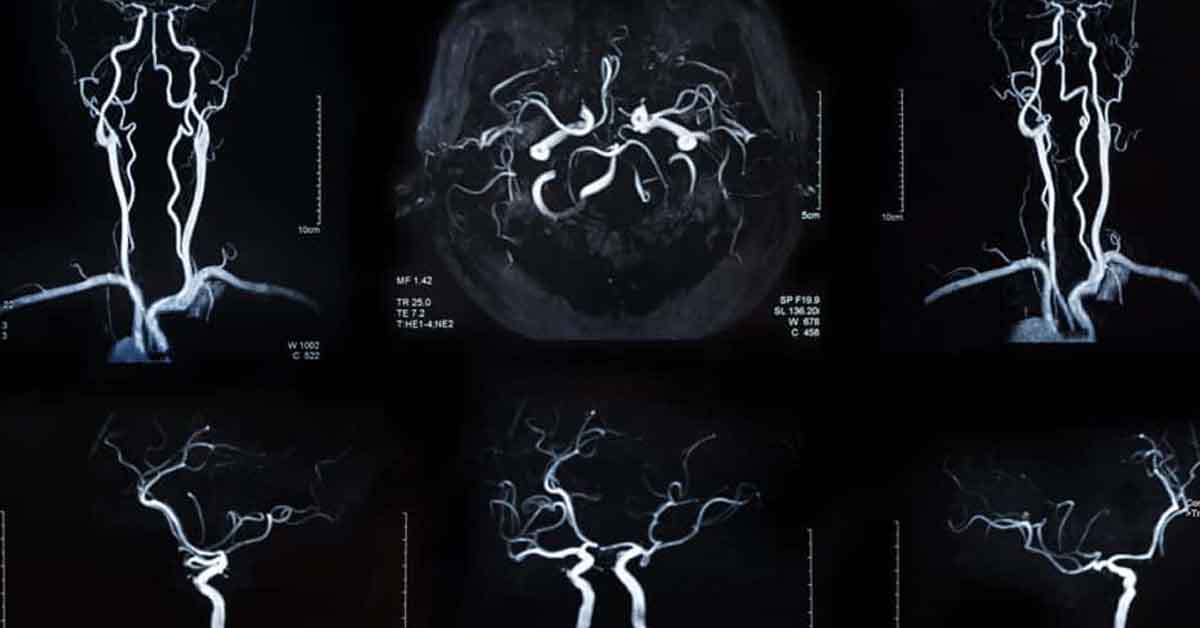 Ateromatose Intracraniana é Normal - RETOEDU