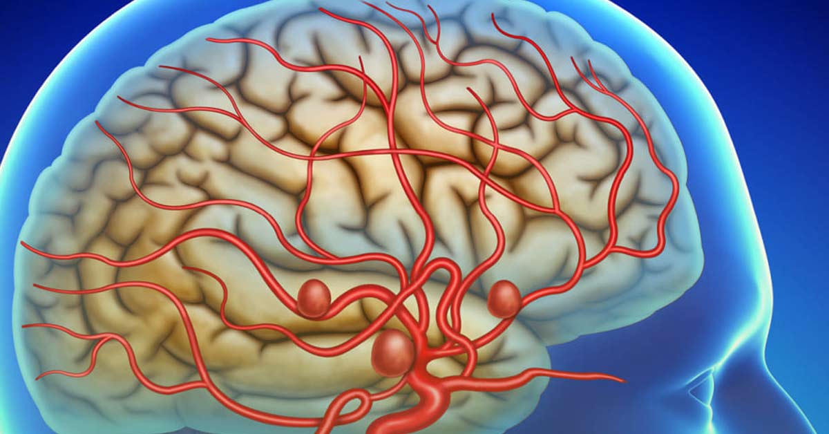 Aneurisma Cerebral Cl nica M dica Dr Renato Tosello Aneurisma Cerebral Cl nica M dica Dr Renato Tosello