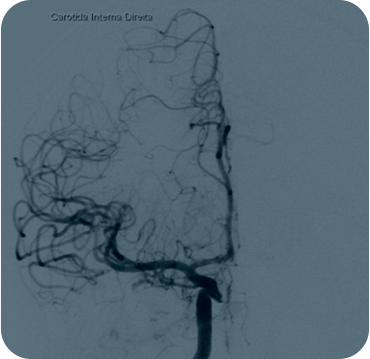Angiografia Cerebral ou Medular