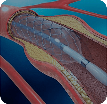 Angioplastia de carótidas