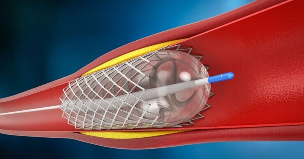 Angioplastia de Carótidas vs. Outros Tratamentos_ Qual Escolher
